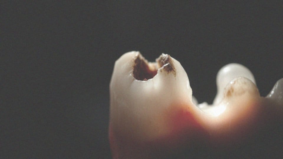 Nieleczone zapalenie okostnej zęba – objawy, leczenie i powikłania