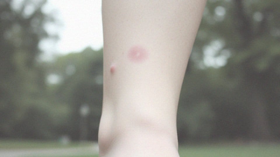 Pękające naczynka na nogach i siniaki – przyczyny oraz leczenie